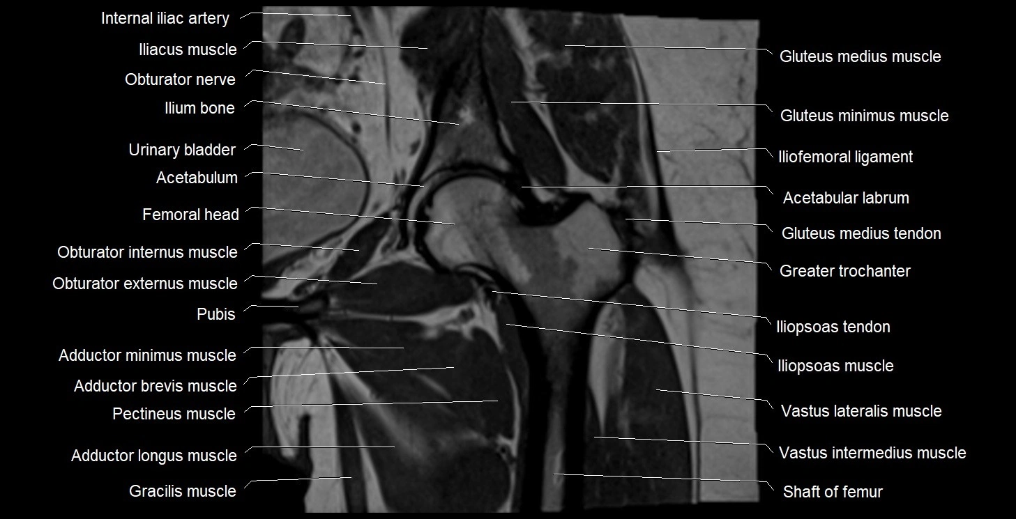 MRI Hip 3T coronal cross sectional anatomy image 31.webp